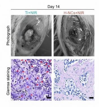 In a rat tibial implant model, on day 14 after surgery, the conventional titanium (upper left) exhibited obvious exudate and pus, indicating severe local infection and inflammation. In contrast, the hydrogenated nano-honeycomb (upper right) showed no obvious exudate or pus. Stained tissue sections further revealed numerous bacteria (red spots in images) in the conventional titanium at day 14, while almost no bacteria were detectable in the hydrogenated nano-honeycomb, highlighting its superior antibacterial performance in vivo.
